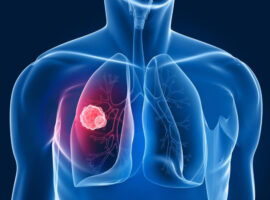 Kasus Kanker Paru pada Non-Perokok Meningkat, Pakar IPB University SHS dan THS Jadi Ancaman Serius