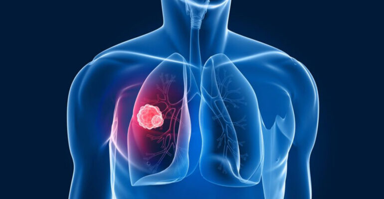 Kasus Kanker Paru pada Non-Perokok Meningkat, Pakar IPB University SHS dan THS Jadi Ancaman Serius