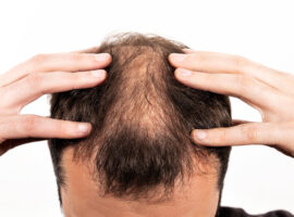 Stres Bisa Picu Kebotakan Ini Penjelasan Psikiater IPB University