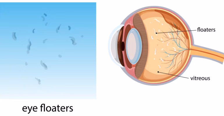 floaters-bukan-akibat-gadget-dokter-mata-ipb-university-jelaskan-penyebab-dan-tanda-bahayanya