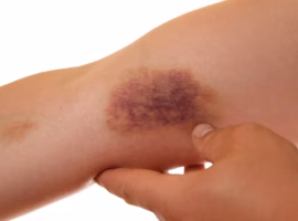 dosen-ipb-university-peringatkan-bahaya-hematoma-pada-atlet-jangan-sepelekan-memar-pascabenturan