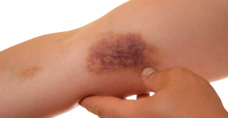 dosen-ipb-university-peringatkan-bahaya-hematoma-pada-atlet-jangan-sepelekan-memar-pascabenturan